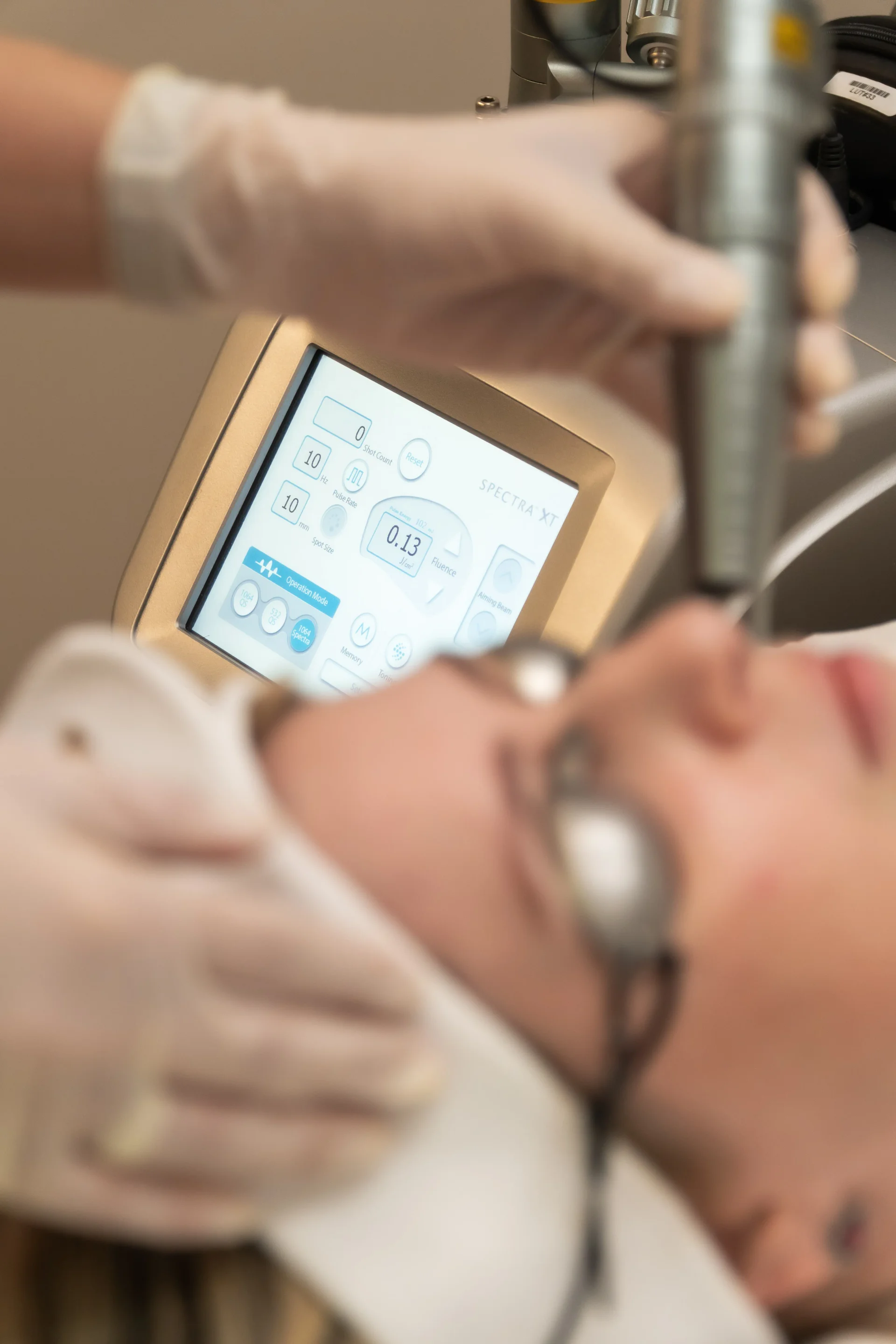 Tecnologia Laser Spectra XT - Spectra XT: laser médico para manchas, melasma, poros dilatados e textura irregular da pele. Avaliação dermatológica em Uberlândia.